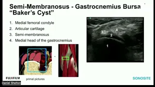 Webinar: Ultrasound Evaluation of the Posterior Knee