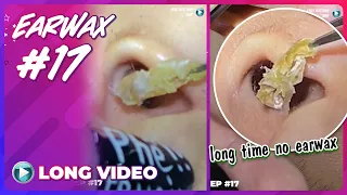 EP 17 Earwax ASMR. Always pay attention to keeping your ears clean to have good ears