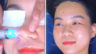 ASMR | Cosmetic Acupuncture | Pore Cleaning | 피부관리