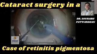 Cataract Surgery in a case of retinitis pigmentosa Dr Sourabh Patwardhan Live Cataract surgery