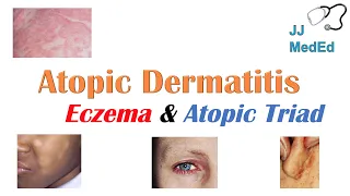 Eczema (Atopic Dermatitis) | Atopic Triad, Triggers, Who gets it, Why does it happen, & Treatment