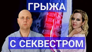 Секвестрированная грыжа позвоночника