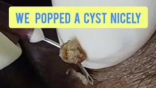 Popping out a tiny cyst near to the eye | @Dr.AMAZINGSKIN