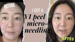 I got a VI chemical peel & microneedling - hyperpigmentation melasma on Asian skin @amillennioldlife