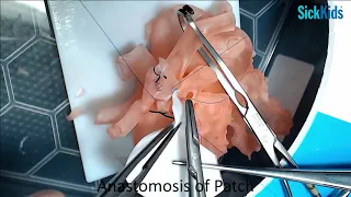 HOST - CoA Repair (End-to-side anastomosis with anterior patch) on 3D model - Dr Osami Honjo