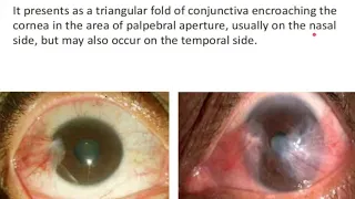 Pterygium | Ophthalmology