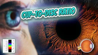 Cup to disc ratio - Your EYEBALLS - EYNTK 👁️👁️💉😳💊🔊💯✅