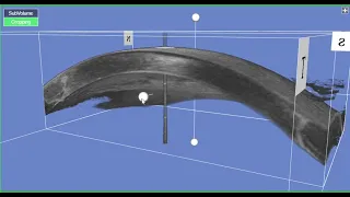 Full Cornea 3D Navigation using TOPCON Triton