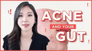 💩How To Treat Acne from the Inside Out • Acne and Gut health