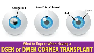 What to Expect When Having a DSEK or DMEK Cornea Transplant