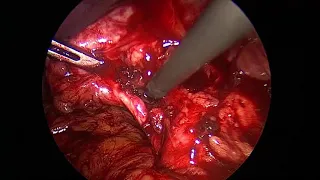 Difficult Laproscopic cholecystectomy acute biliary pancreatitis part-2 by Dr Ajay Yadav