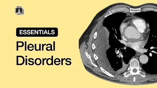 Pleural Disorders | Chest Radiology Essentials