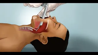 "Pediatric Endotracheal Intubation" by Josh Nagler for OPENPediatrics