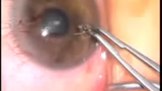 Dr. Feinerman Removes Metal Fragment From Eye