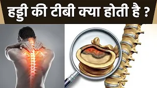 हड्डी की टीबी क्या है । हड्डी की टीबी के कारण और लक्षण । Boldsky *Health