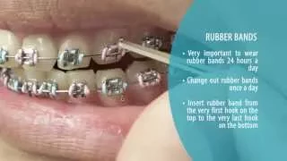 How to Brush and Maintain your Teeth with Braces
