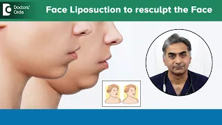 How to lose Facial Fat Face?| Face Liposuction| How to slim your face?-Dr.Srikanth V|Doctors' Circle