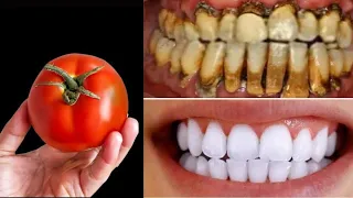 Teeth Whitening At Home In 3 Minutes || How To Whiten Your Yellow Teeth Naturally || 100% Effective