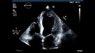 Dilated Cardiomyopathy