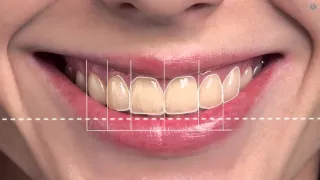 Digital Smile Design - Animation