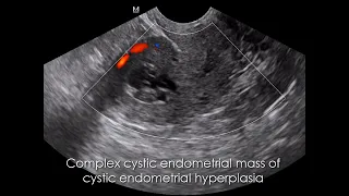 CASE 1096 cystic endometrial hyperplasia