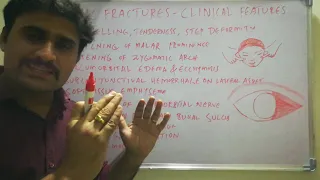 ZMC FRACTURES - Clinical features and diagnosis