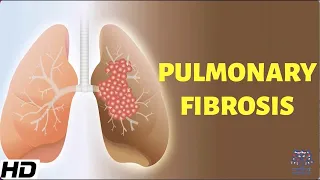 Pulmonary Fibrosis: Everything You Need To Know