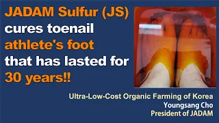 JADAM Sulfur (JS) cures toenail athlete's foot that has lasted for 30 years!!