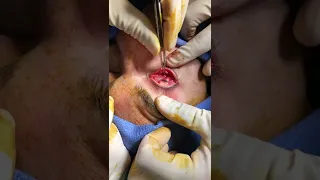 Orbital Floor Fracture Video 3