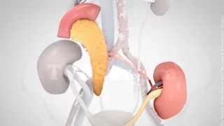 Synchronous pancreas-kidney (SPK) transplant