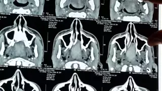 JNA CT-Scan lecture [ Brief = Rapid CT lecture ] - Dr. Satish Jain - www.skullbase360.in