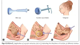 Obstetrics 681 Ventouse Vacuum Delivery Procedure Contraindications Operative Chignon