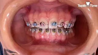 How they put braces on - 15 years old patient - Tooth Time Family Dentistry New Braunfels Texas