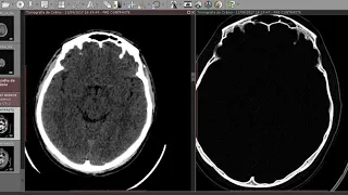 Imagem do Crânio e Encéfalo Diferenças entre TC, RM T1, T2 e FLAIR