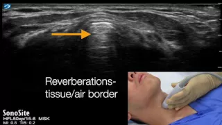 Cricothyroid membrane identification with ultrasound - transverse approach