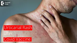 URTICARIAL RASH AFTER COVID VACCINE | How long does it last? - Dr. Surekha Tiwari | Doctors' Circle