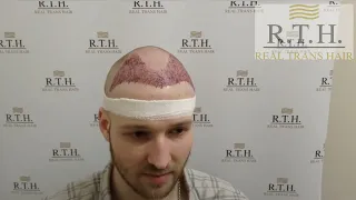 15 дней после пересадки волос в Москве в клинике Real Trans Hair