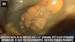 Grávida nega ir ao médico até a 41ª semana, até algo estranho aparecer. O que foi descoberto...