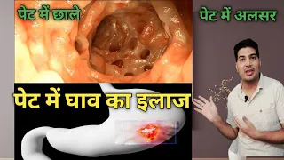 पेट में घाव का इलाज |  pet mein ulcer ka ilaaj | pet me ghav ka ilaj | pet me chala kaise thik kare