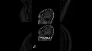 MRI – T1w 3D SPACE OPTIMIZING