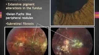 Ophthalmology - Uvea Class5: Panuveitis Part2