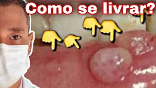 BOLHA NO LÁBIO | MUCOCELE, Sai sozinha? Dá pra tirar em casa? QUANTO CUSTA pra TIRAR?