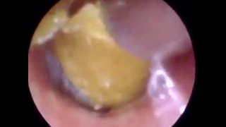 Removing ear wax off the eardrum! Not for the faint-heated!