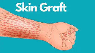 Skin Graft Healing And After Care