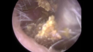 Impacted Ear Wax with Q-tip indentation Visible Removal - Mr Neel Raithatha (The Hear Clinic)