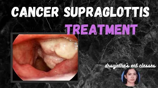 101.Treatment of Cancer Larynx: Carcinoma Supraglottis  #larynx #treatment #laryngoscope