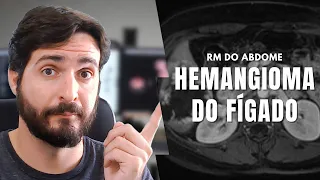 Hemangioma do fígado: o nódulo mais comum na RM do abdome superior. | Galvani Filho