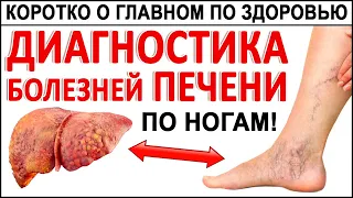 Первые Признаки больной Печени! Их видно по ногам! Если Ваша ПЕЧЕНЬ НЕЗДОРОВА, то тогда вот что.