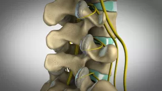 Orlando Chiropractic - Custom 3D animation visualizing facet syndrome and how chiropractic can help