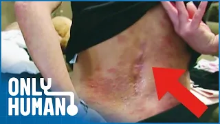 Living with Psoriasis (Hidden Skin Disease) | Medical Documentary | Only Human